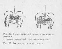 Хвороби зубів, терапевтична стоматологія (коронкової частини зуба) Хвороби зубів, терапевтична стоматологія