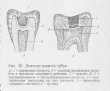 Хвороби зубів, терапевтична стоматологія (зубів) Хвороби зубів, терапевтична стоматологія