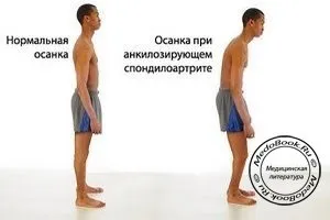 Виразкової хвороби шлунку клініка, лікування, прогноз, медична література, книги з медицини, підручники, (синдром) Виразкової хвороби шлунку клініка, лікування, прогноз, медична література, книги з медицини, підручники,