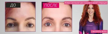 Блефаропластика нижня, верхня блефаропластика (значні поліпшення помітні) Блефаропластика нижня, верхня блефаропластика