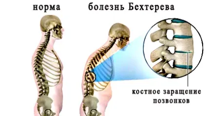 Хвороба Бехтерева симптоми діагностика лікування (лікування захворювань опорно-рухового апарату) Хвороба Бехтерева симптоми діагностика лікування