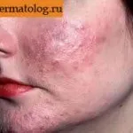 Центр видалення родимок