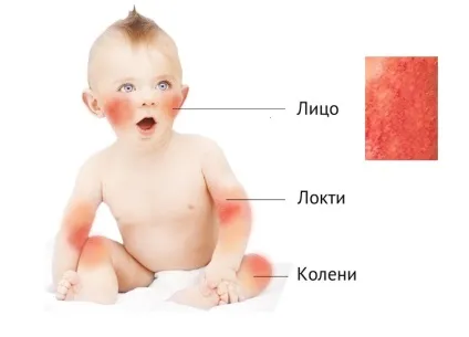Короста у дітей як вона виглядає симптоми і фото у дитини (дитини) Короста у дітей як вона виглядає симптоми і фото у дитини