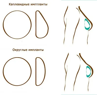 Імпланти після маммопластики - чи потрібно міняти (маммопластики) Імпланти після маммопластики - чи потрібно міняти