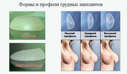 Імпланти після маммопластики - чи потрібно міняти (потрібно) Імпланти після маммопластики - чи потрібно міняти