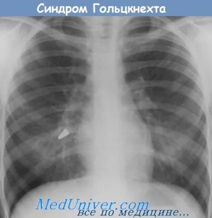 Сторонні тіла в бронхах і легенях (чужорідні тіла бронхах) Сторонні тіла в бронхах і легенях