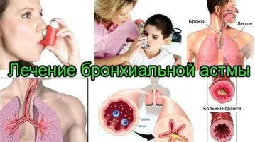 Як вилікувати бронхіальну астму назавжди у дітей і дорослих, лікування нападу народними засобами (вилікувати) Як вилікувати бронхіальну астму назавжди у дітей і дорослих, лікування нападу народними засобами