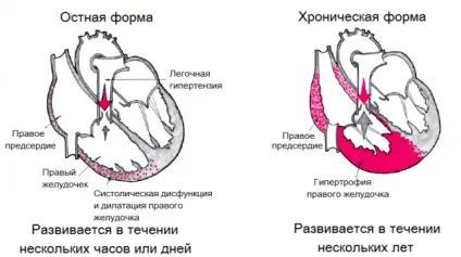 Як вилікувати бронхіальну астму назавжди у дітей і дорослих, лікування нападу народними засобами (вилікувати) Як вилікувати бронхіальну астму назавжди у дітей і дорослих, лікування нападу народними засобами