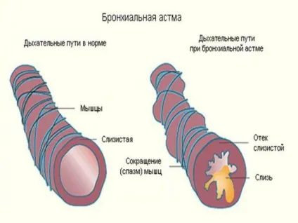 Як вилікувати бронхіальну астму назавжди у дітей і дорослих, лікування нападу народними засобами (вилікувати) Як вилікувати бронхіальну астму назавжди у дітей і дорослих, лікування нападу народними засобами