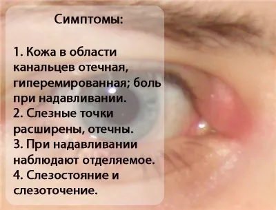 Каналікуліт у дітей - симптоми хвороби, профілактика і лікування каналікулітів у дітей, причини (симптоми) Каналікуліт у дітей - симптоми хвороби, профілактика і лікування каналікулітів у дітей, причини