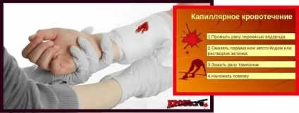 Капілярна кровотеча - лікування кровотеч (допомога) Капілярна кровотеча - лікування кровотеч