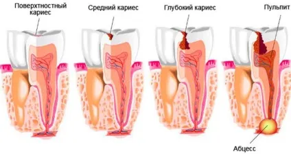 Карієс у дітей причини карієсу молочних зубів, лікування (карієс) Карієс у дітей причини карієсу молочних зубів, лікування