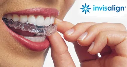 Капи invisalign - ціни на капи Инвизилайн, порівняння з брекетами - стоматологічний портал