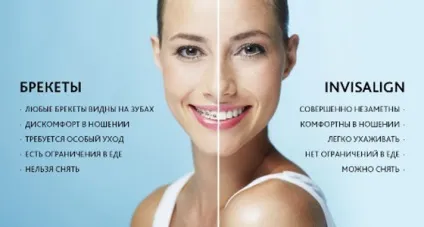 Капи invisalign - ціни на капи Инвизилайн, порівняння з брекетами - стоматологічний портал