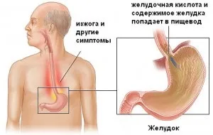 Катаральний рефлюкс езофагіт симптоми, лікування (езофагіт) Катаральний рефлюкс езофагіт симптоми, лікування