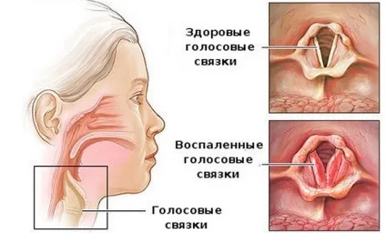 Кашель при ларингіті скільки тримається, як і чим лікувати