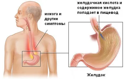 Катаральний рефлюкс езофагіт діагностика і лікування (езофагіт) Катаральний рефлюкс езофагіт діагностика і лікування