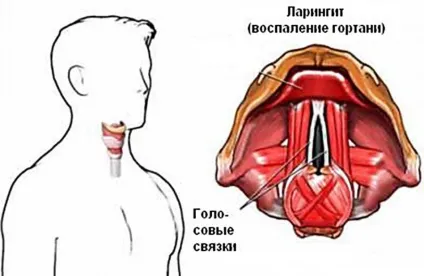 Катаральний ларингіт у дітей і дорослих симптоми і лікування (ларингіт) Катаральний ларингіт у дітей і дорослих симптоми і лікування