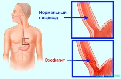 Катаральний рефлюкс езофагіт що це таке причини, діагностика та лікування (рефлюкс) Катаральний рефлюкс езофагіт що це таке причини, діагностика та лікування