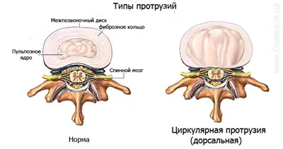 Класифікація протрузии міжхребцевих дисків (протрузії) Класифікація протрузии міжхребцевих дисків
