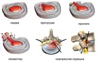 Класифікація протрузии міжхребцевих дисків (міжхребцевих) Класифікація протрузии міжхребцевих дисків