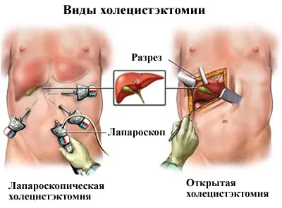 Кіста жовчного міхура причини, симптоми, лікування (міхура) Кіста жовчного міхура причини, симптоми, лікування
