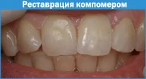 Компомери склад, види, кращі представники, переваги і недоліки (склад) Компомери склад, види, кращі представники, переваги і недоліки
