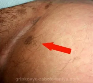 Коричневі плями в паху причини, лікування (паху) Коричневі плями в паху причини, лікування