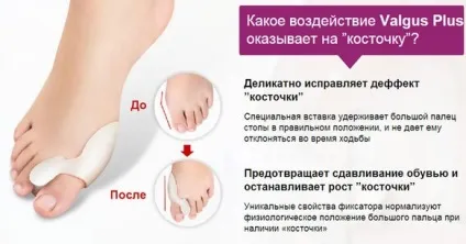 Кісточка на нозі причини появи, методи лікування, профілактика (появи) Кісточка на нозі причини появи, методи лікування, профілактика
