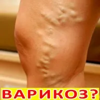 Лікування тромбозу вен нижніх кінцівок список препаратів, народні засоби, заходи профілактики (лікування) Лікування тромбозу вен нижніх кінцівок список препаратів, народні засоби, заходи профілактики