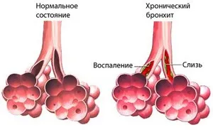 Лікування хронічного бронхіту антибіотиками (лікування хронічного бронхіту) Лікування хронічного бронхіту антибіотиками