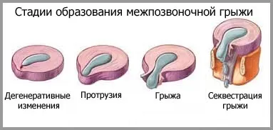 Лікувальна гімнастика при поперекової грижі хребта (гімнастика) Лікувальна гімнастика при поперекової грижі хребта