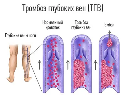Лікування тромбозу вен нижніх кінцівок список препаратів, народні засоби, заходи профілактики (лікування тромбозу вен нижніх кінцівок) Лікування тромбозу вен нижніх кінцівок список препаратів, народні засоби, заходи профілактики