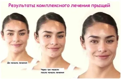 Лактофільтрум від прищів показання, застосування, відгуки (показання) Лактофільтрум від прищів показання, застосування, відгуки