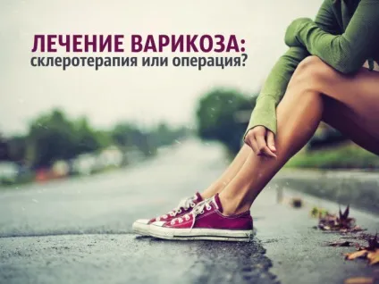 Лікування варикозу склеротерапія або операція, лікар (лікування) Лікування варикозу склеротерапія або операція, лікар