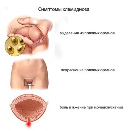 Лікування хламідіозу народними засобами в домашніх умовах (лікування) Лікування хламідіозу народними засобами в домашніх умовах