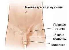 Лобкова кістка у жінок і чоловіків - будова, болю (жінок) Лобкова кістка у жінок і чоловіків - будова, болю