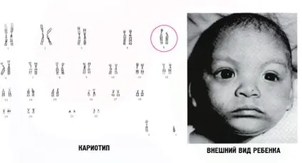 Маленька голова що за хвороба, причини і лікування (маленька) Маленька голова що за хвороба, причини і лікування