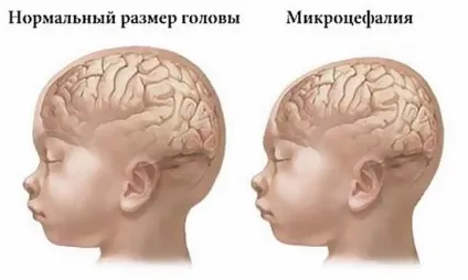 Маленька голова що за хвороба, причини і лікування (маленький обсяг голови) Маленька голова що за хвороба, причини і лікування