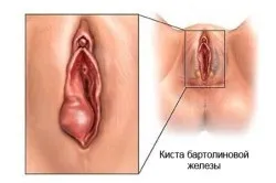 Марсупіалізація кісти бартолінової залози (кісти бартолінової залози) Марсупіалізація кісти бартолінової залози