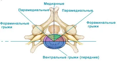 Медіа Парамедіанна грижа диска l5 s1 методи лікування (Парамедіанна) Медіа Парамедіанна грижа диска l5 s1 методи лікування