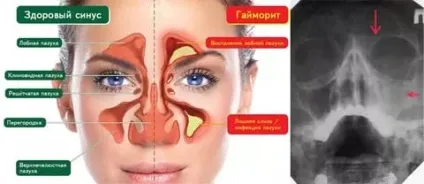 Мазь від гаймориту з господарським милом рецепт (рецепт) Мазь від гаймориту з господарським милом рецепт