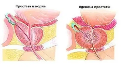 Мазь від простатиту