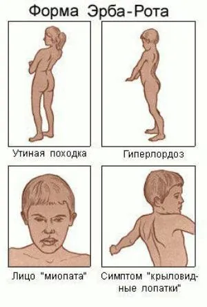 Міопатія Ерба - що преставляет собою це захворювання (захворювання) Міопатія Ерба - що преставляет собою це захворювання