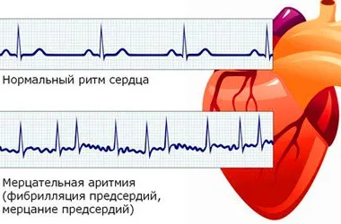 Миготлива аритмія серця причини, симптоми і лікування (причини) Миготлива аритмія серця причини, симптоми і лікування