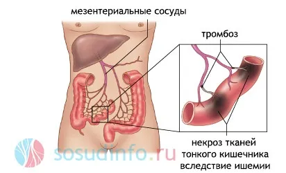 Мезентеріальний тромбоз судин кишечника причини, симптоми, лікування (симптоми) Мезентеріальний тромбоз судин кишечника причини, симптоми, лікування