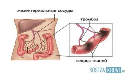 Мезентеріальний тромбоз судин кишечника первинний, вторинний, симптоми, причини, діагностика та