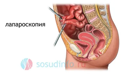 Мезентеріальний тромбоз судин кишечника причини, симптоми, лікування (симптоми) Мезентеріальний тромбоз судин кишечника причини, симптоми, лікування