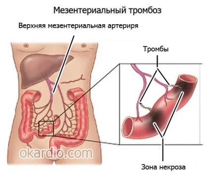 Мезентеріальний тромбоз причини, симптоми, діагностика та лікування