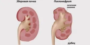 Чи можна при циститі грітися грілкою або пляшкою (грітися) Чи можна при циститі грітися грілкою або пляшкою